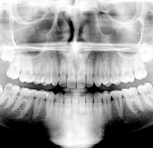 En el dentista Clinica Dental Puerta del Sur realizamos ortopantomografía con muy buenos resultados
