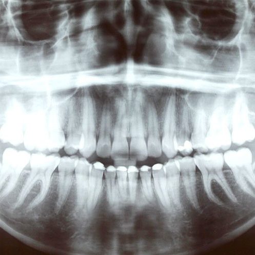 En el dentista Clinica Dental Puerta del Sur realizamos radiovisiografía con muy buenos resultados