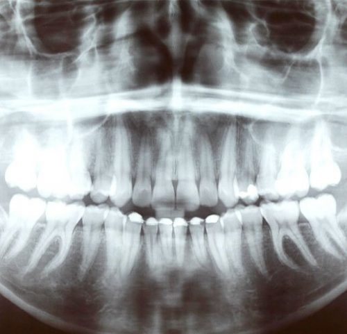 En el dentista Clinica Dental Puerta del Sur realizamos radiovisiografía con muy buenos resultados